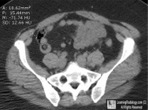 Small Bowel Lipoma